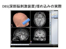 パーキンソン氏病の治療