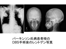 パーキンソン氏病の治療