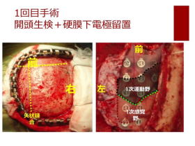 てんかんに対する焦点切除術
