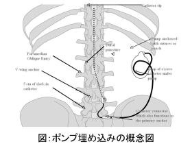 痙性麻痺に対するバクロフェン髄注療法(ITB)