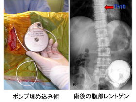 痙性麻痺に対するバクロフェン髄注療法(ITB)