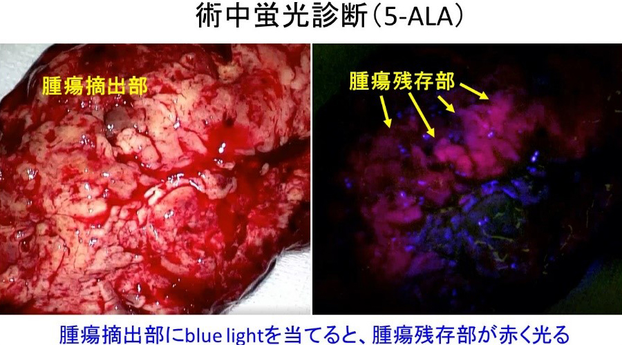 術中蛍光診断