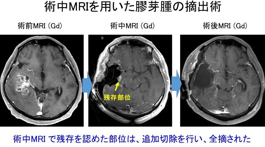 術中MRI