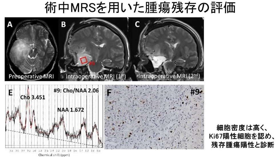 術中MRIスペクトロスコピー（MRS）