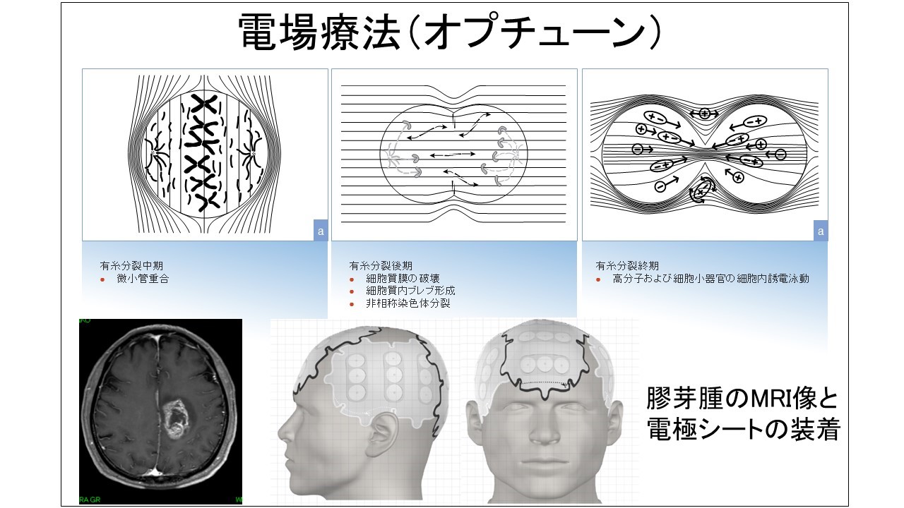 膠芽腫に対する電場療法（オプチューン）