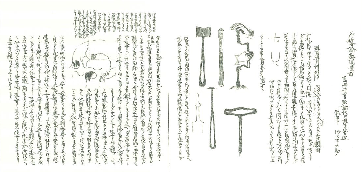 頭蓋骨手術（Trepanation穿頭術）