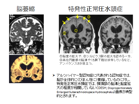 水頭症