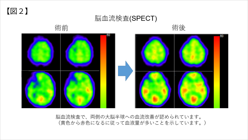 もやもや病