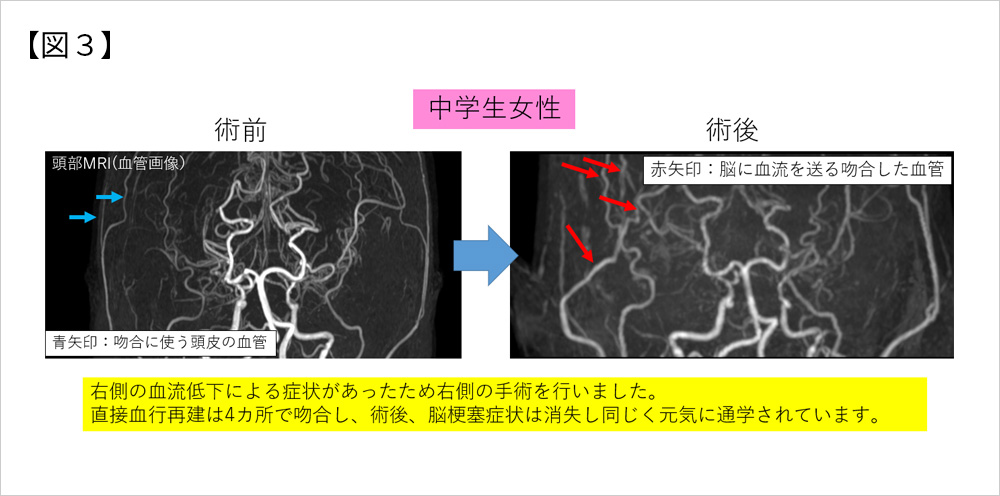 もやもや病