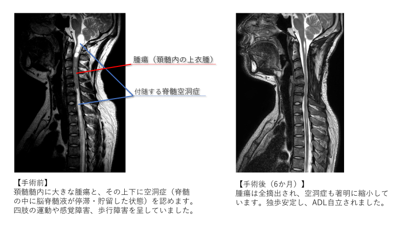 脊髄腫瘍