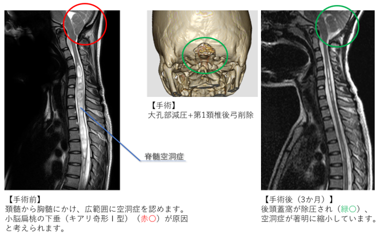 キアリ奇形に伴う脊髄空洞症の一例