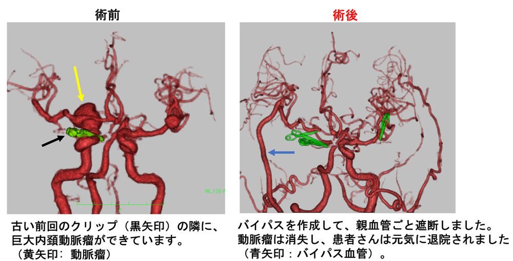 消える 脳 動脈 瘤 未破裂脳動脈瘤が発見されたときの注意点