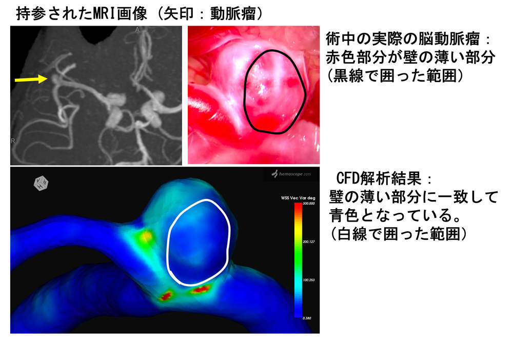 脳 動脈 瘤 消える