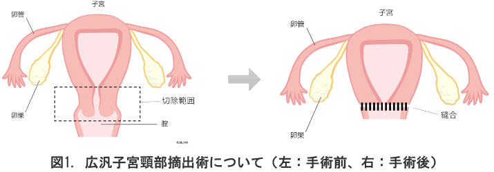 広汎子宮頸部摘出術について(左:手術前、右:手術後)