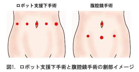 ロボット支援下手術と腹腔鏡手術の創部イメージ