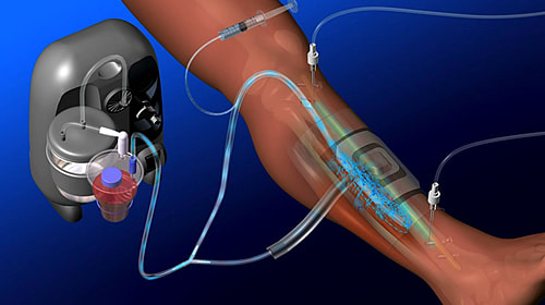 持続局所抗菌薬還流法：Continuous Local Antibiotics Perfusion(CLAP) 図1