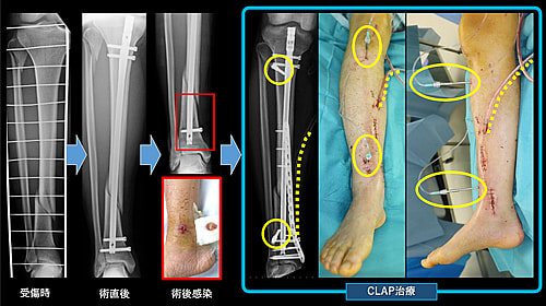 持続局所抗菌薬還流法：Continuous Local Antibiotics Perfusion(CLAP) 図2