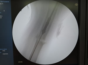 RIA systemを大腿骨髄腔内に挿入している手術中のX線透視画