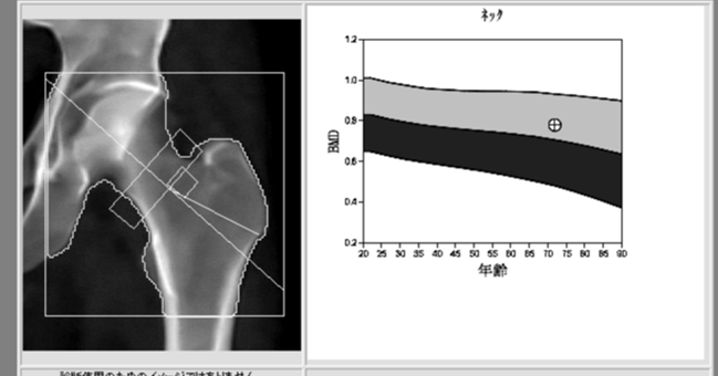 骨密度検査：DXA（Dual Energy X-Ray Absorptiometry）法