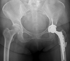 人工股関節再置換術および難治症例レントゲン