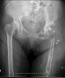 人工股関節再置換術および難治症例レントゲン
