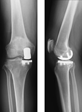 人工膝関節部分置換術後レントゲン
