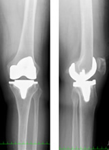 人工膝関節全置換術後レントゲン