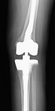 人工膝関節再置換術後レントゲン