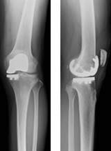 人工膝関節部分置換術後レントゲン