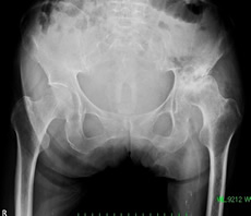 変形性股関節症レントゲン