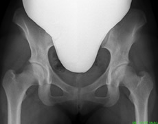 寛骨臼形成不全レントゲン