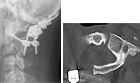腫瘍と片側環椎の一塊切除、脊柱再建