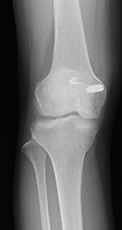 内側膝蓋大腿靭帯再建術後レントゲン