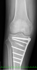 高位脛骨骨切り術後レントゲン