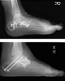 扁平足手術後レントゲン