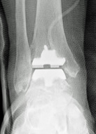 人工足関節置換術後レントゲン