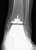 Hybrid人工足関節置換術後レントゲン