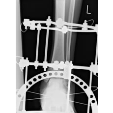 創外固定術手術のレントゲン像