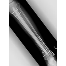 脛骨髄内釘手術のレントゲン像