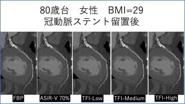 TrueFidelity imaging (TFI)によるノイズ低減効果についての研究